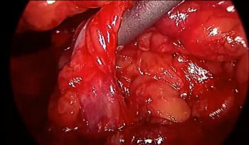 Retroperitoneal-Fibrozis