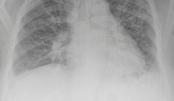 Retroperitoneal Fibroz
