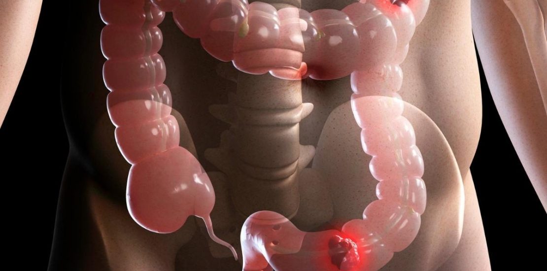 üreter kanseri nedir