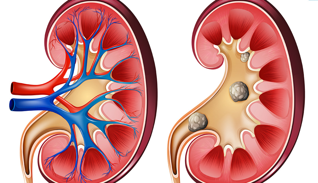 sessiz böbrek taşı